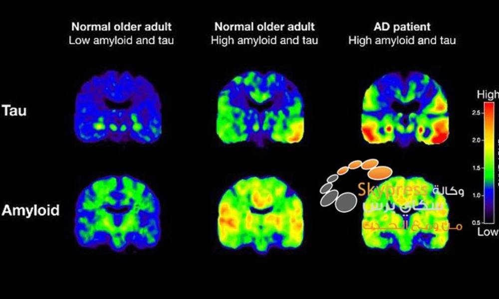 اختبار يمكن أن يكشف خطر الإصابة بمرض الزهايمر