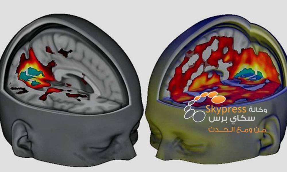 العلماء يكشفون تأثير حبوب الهلوسة على المخ