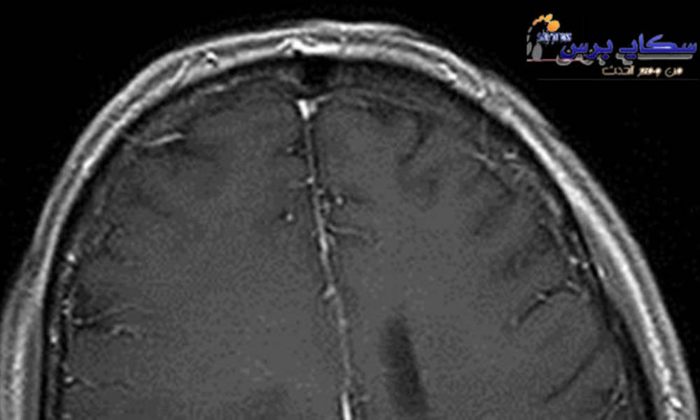 تجربة تبعث أملاً لعلاج اورام المخ