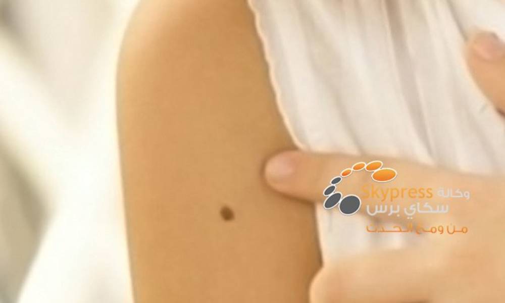كثرة الشامات على اليدين تظهر استعداداً لسرطان الجلد