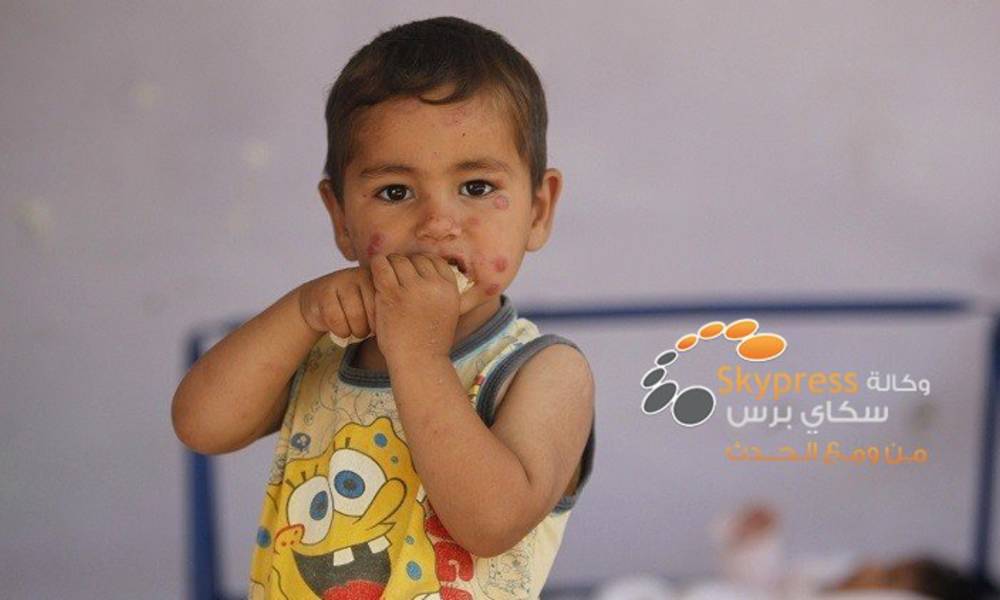 وباء "اللشمانيا" يعصف بالمدن السورية بسبب داعش