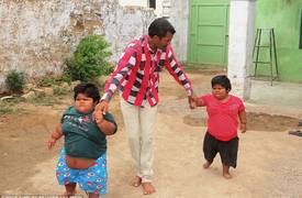 طفلتان هنديتان تمشيان لأول مرة بعد معاناة مع السمنة المفرطة
