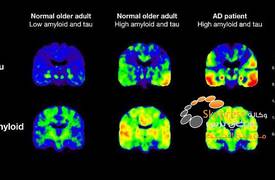 اختبار يمكن أن يكشف خطر الإصابة بمرض الزهايمر